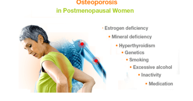 Postmenopausal Osteoporosis