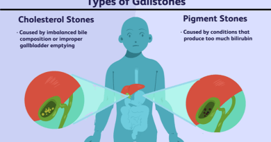 Gallstones: Causes, Symptoms, and Treatment