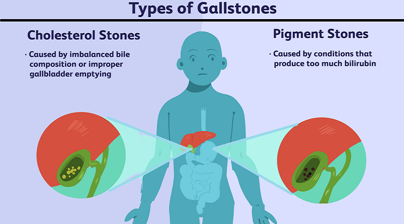 Gallstones: Causes, Symptoms, and Treatment