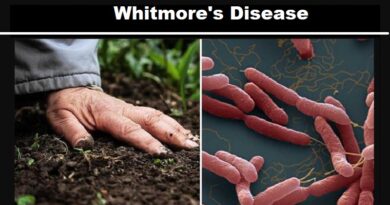 Whitmore's Disease: An Emerging Health Concern