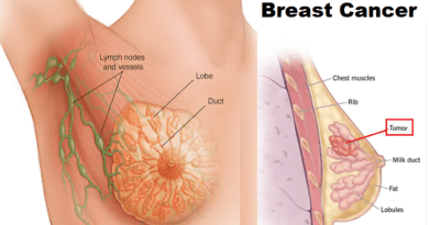 Breast Cancer: Unveiling the Truth