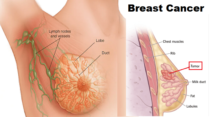Breast Cancer: Unveiling the Truth
