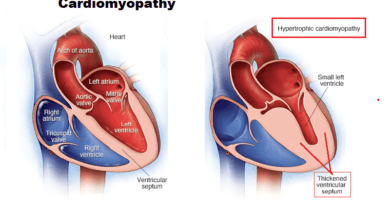 Cardiomyopathy