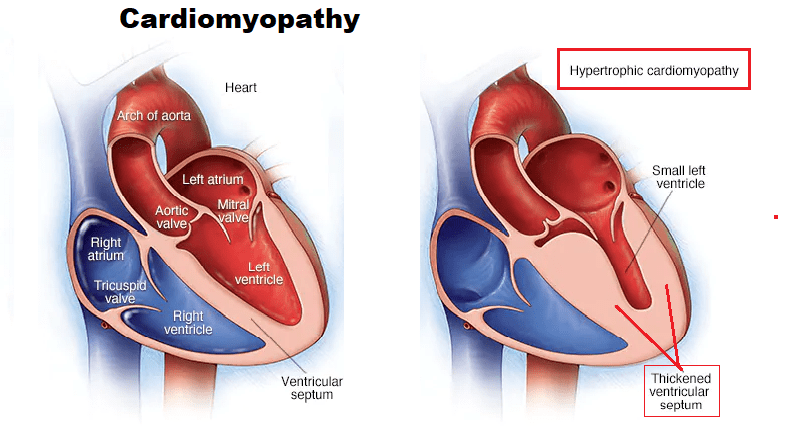Cardiomyopathy