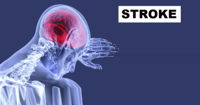 Stroke: The Silent Threat to Brain Health