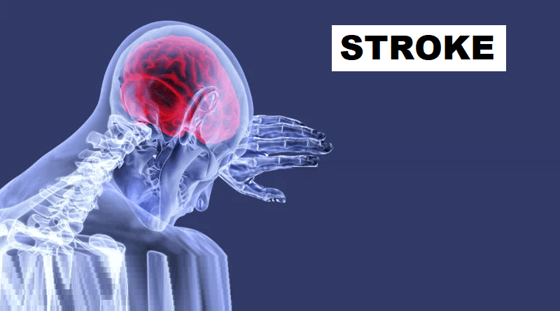 Stroke: The Silent Threat to Brain Health
