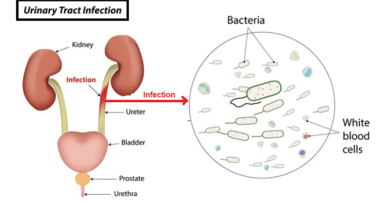 Understanding Urinary Tract Infections (UTIs)
