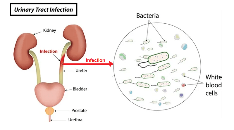 Understanding Urinary Tract Infections (UTIs)