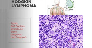 Hodgkin Lymphoma