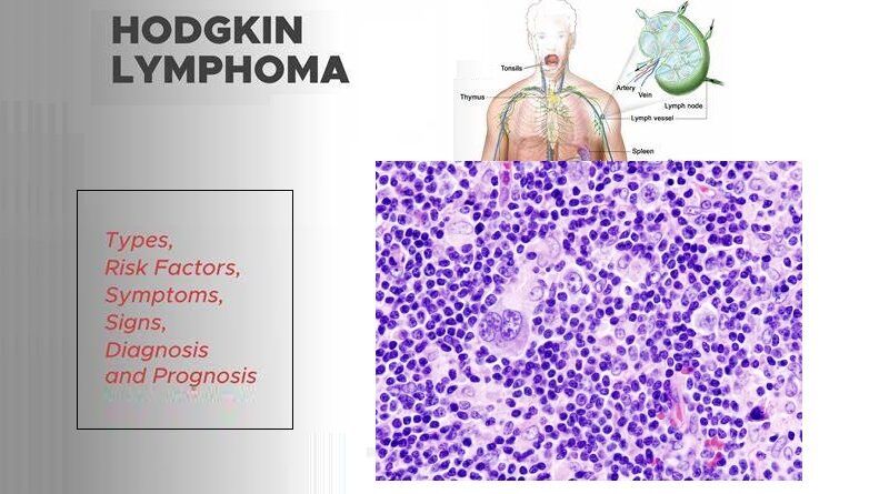 Hodgkin Lymphoma