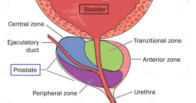 Prostate Cancer: Understanding the Silent Battle Within