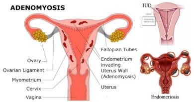 Menorrhagia, severe menstrual bleeding