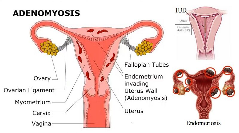 Menorrhagia, severe menstrual bleeding