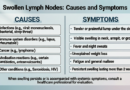 Swollen lymph Nodes: Causes, Symptoms, and Treatment Options